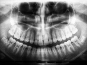 best dentist in Tijuana, x-rays