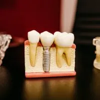 Dental implant in Mexico